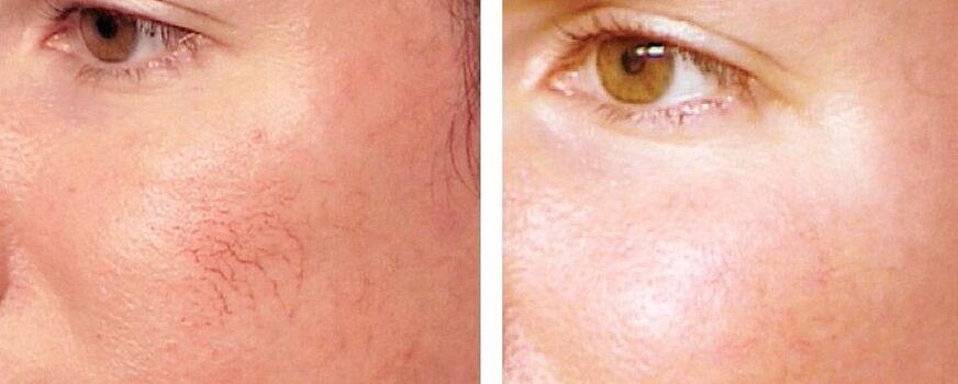 Jarak dari Rosacea