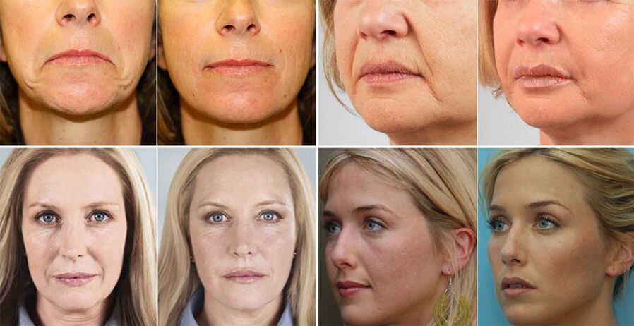 Gambar wanita sebelum dan selepas peremajaan kulit muka